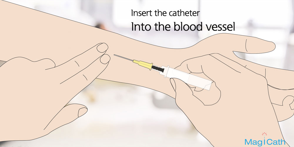 Insert the catheter Into the blood vessel